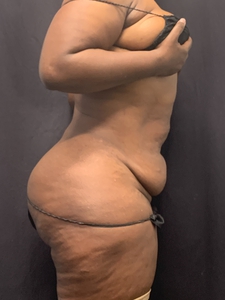 LAL-upper  + Lower abdomen + avelar tuck-before