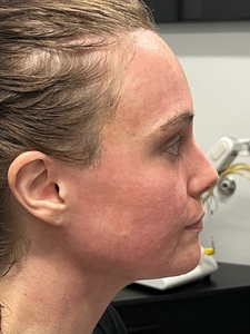 MLP + Profractional + BBL-before