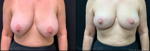 5'8 165# 1 mo post-op Auto-Augmentation with Mastopexy-before