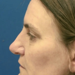 Brow & Eye Lift #1-before