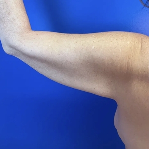 Lipo w Renuvion #4-before