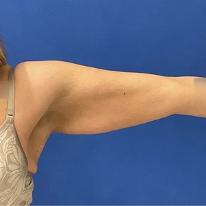 Lipo w Renuvion #11-before