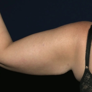 Lipo w BodyTite #7-after