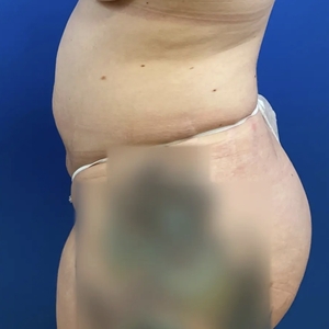 Lipo w Renuvion #8-after