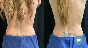 coolsculpting-before