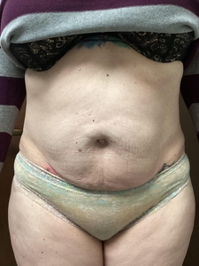 Edge 6 Treatments-before