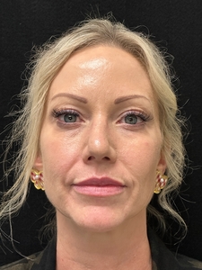 1 syringe of Volbella-after