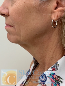 Jaw line filler-after