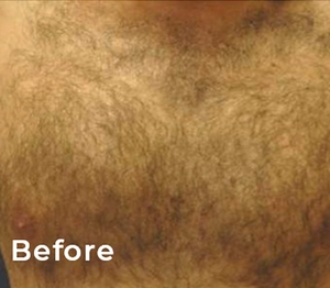 Laser Hair Removal #2-before
