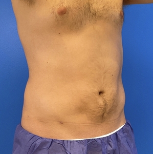 Liposuction #4-after