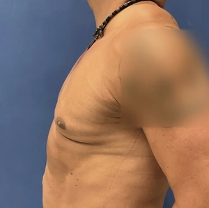 Male Breast Reduction #4 (left)-after