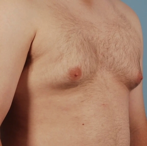 Male Breast Reduction #12-before