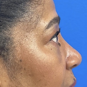 Brow & Eye Lift #1-after