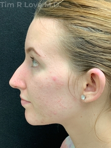 2 Weeks Post Op-before