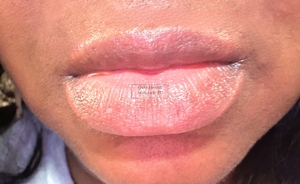 Belotero Lip Filler (Top Lip)-after