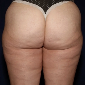 Cellulite Reduction #3-after