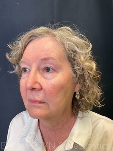 lower face +neck-after