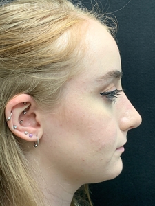 1 month post op-after