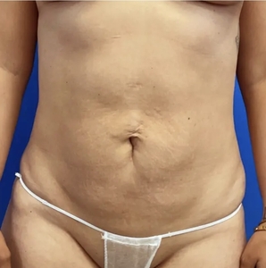 Lipo w Renuvion #5-after