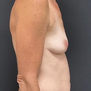 Breast Augmentation #18 385 cc-before