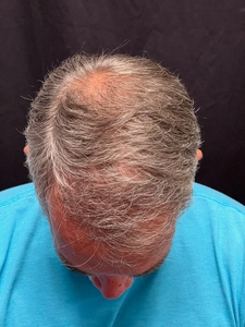 Neograft 1400 grafts-before