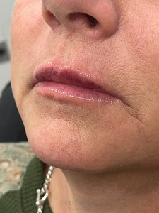 Tori Atkins RN, Versa-after