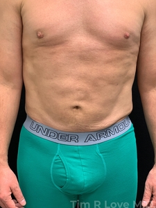 Abdominoplasty - Mini-after