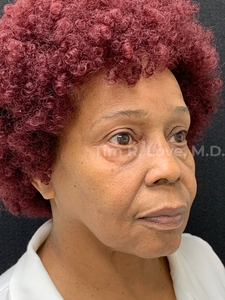 Blepharoplasty - Lower-before