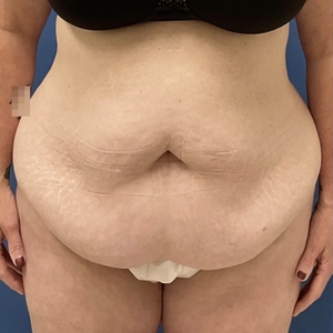 Tummy Tuck #1 (front)-before