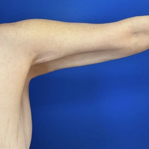 Lipo w Renuvion #4-before