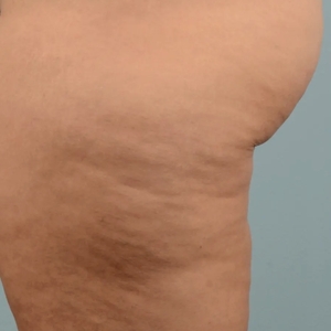 Cellulite Reduction #3-before