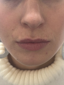 SaijeB&A_lipflip-before