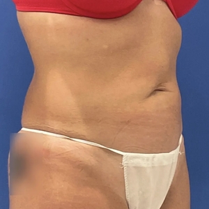 Tummy Tuck #15-before