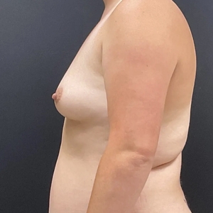 Breast Augmentation #11 650 cc-before
