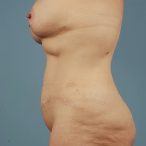 Mommy Makeover #12-after