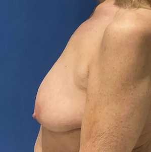 Breast Augmentation #8 590 cc-before