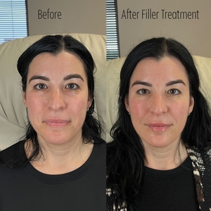 Filler B/A SBA 5-before