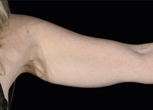 Emsculpt NEO #4-before