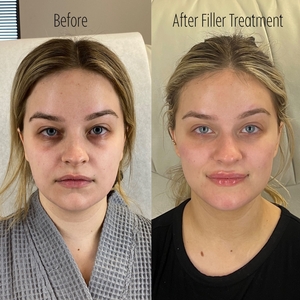 Filler B/A SBA 4-before