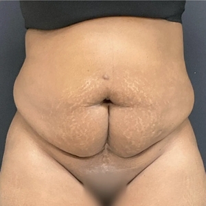 Tummy Tuck #8-before