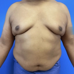 Lipo w Renuvion #9-before