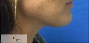 1 Coolsculpting TX -Laura Pruitt-after