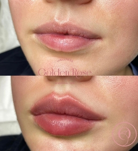 Lip Fillers-before