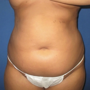 Patient 16: Upper/lower abdomen, flanks - 3 Months-before