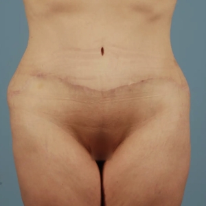 Mommy Makeover #12-after