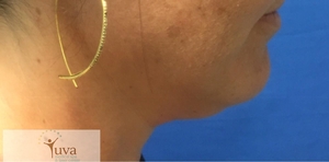 1 Coolsculpting TX -Laura Pruitt-before