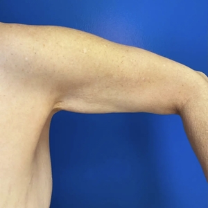 Lipo w Renuvion #4-before