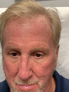 PIQO4 Lentigos-before