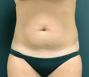 Liposuction #2-before