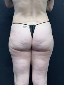 LAL-outer thighs-before